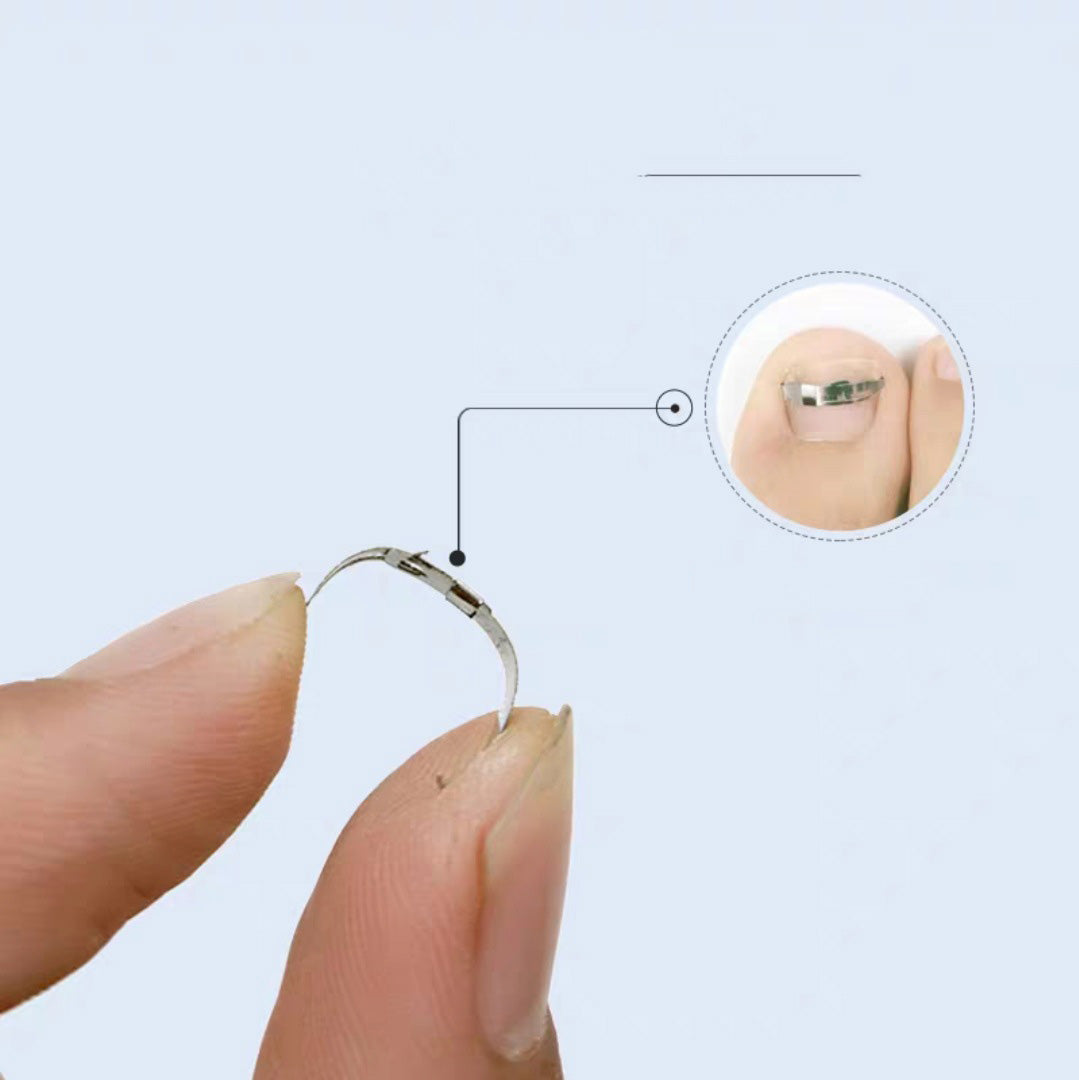 Orthognathic Buckle Nail Groove Ingrown Nail Correction Device