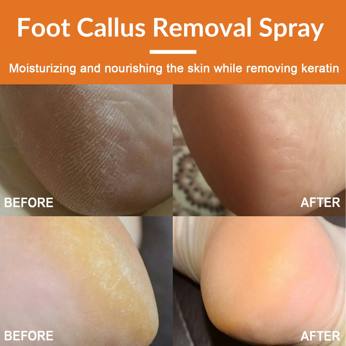 Foot Exfoliating Spray Mild Callose Remove Dead Skin