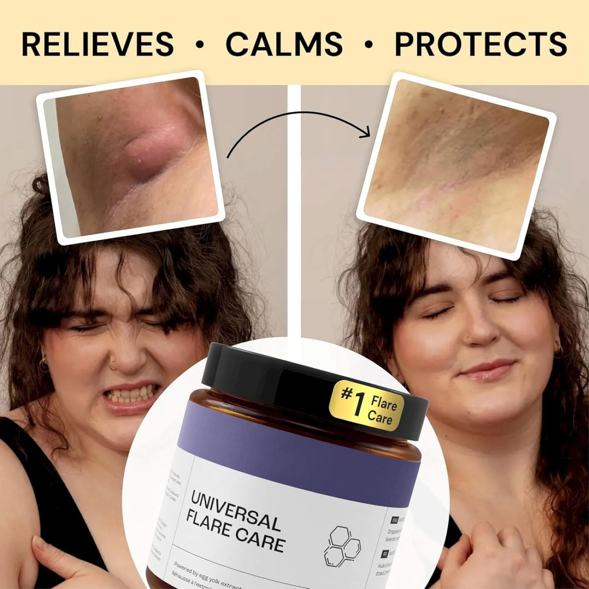 U Niversal | R Elieve Skin Problems | Hidradenitis