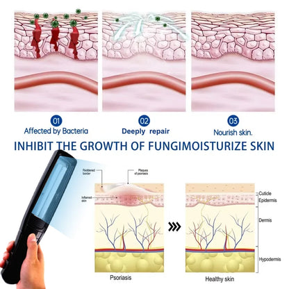 Ultraviolet Phototherapy Instrument Use UVB Lamp