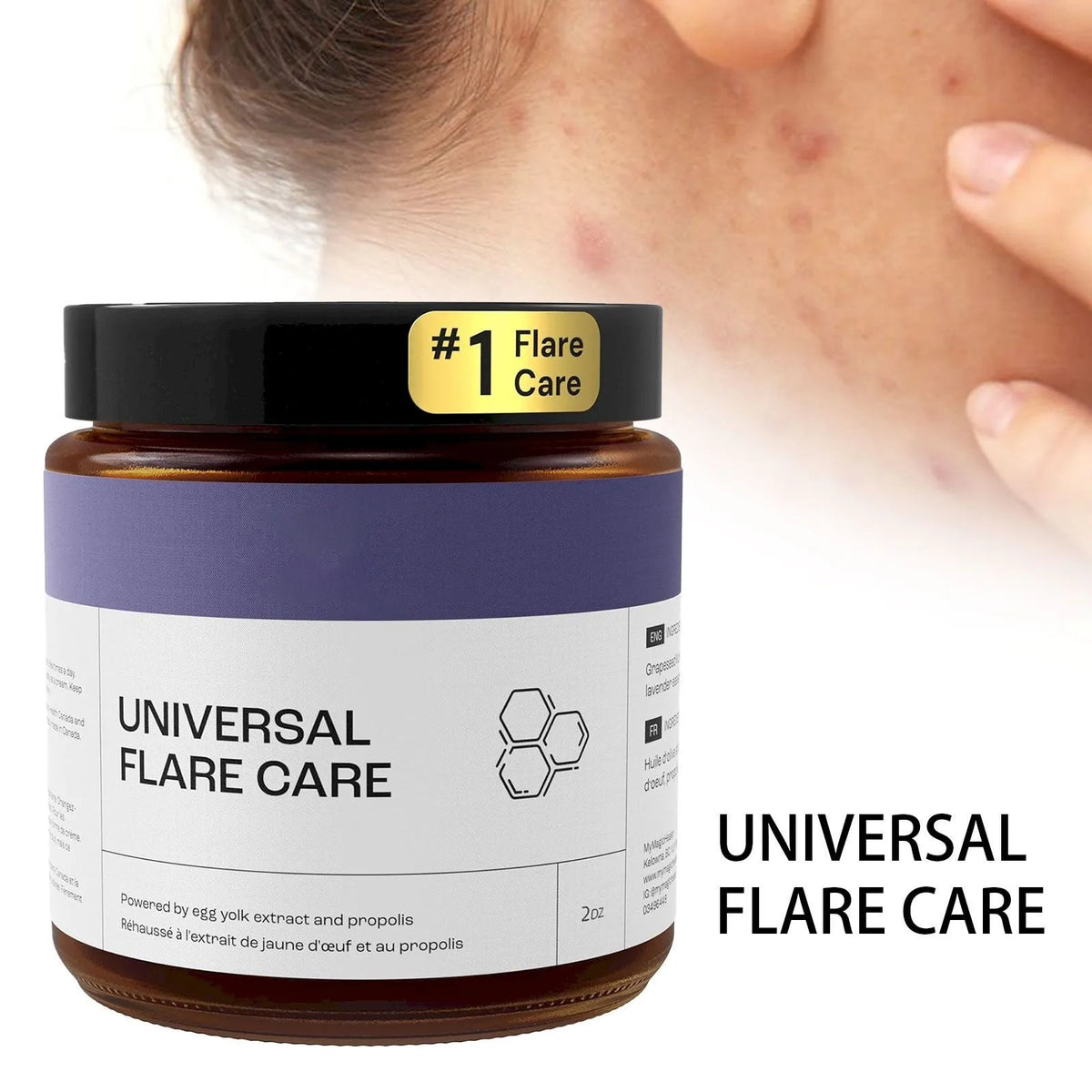 U Niversal | R Elieve Skin Problems | Hidradenitis