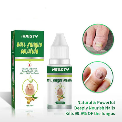 Nail Fungal Treatment Feet Care Nail Foot Toe Nail Fungus Removal Gel
